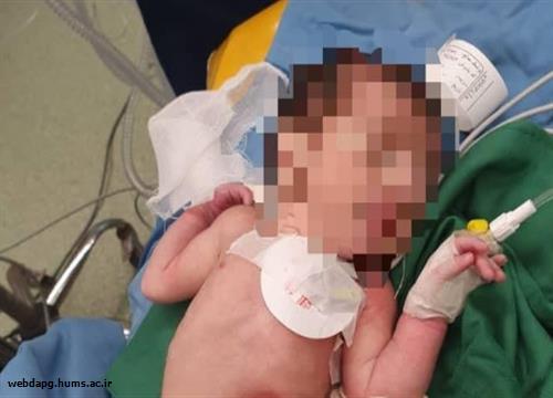 انجام موفقیت آمیز عمل جراحی نوزاد با ناهنجاری گاستروشزی در بیمارستان کودکان بندرعباس